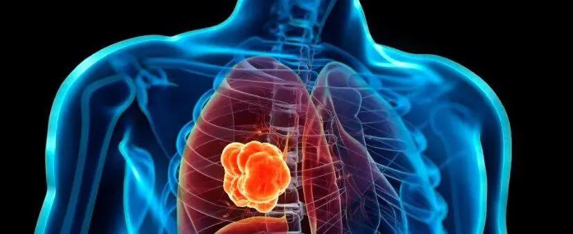 海陆空联合作战完整版,联合治疗肺癌