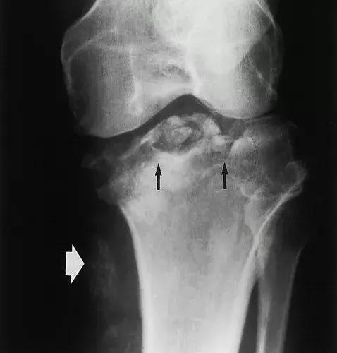 神经性骨关节病,神经性关节炎症状图片