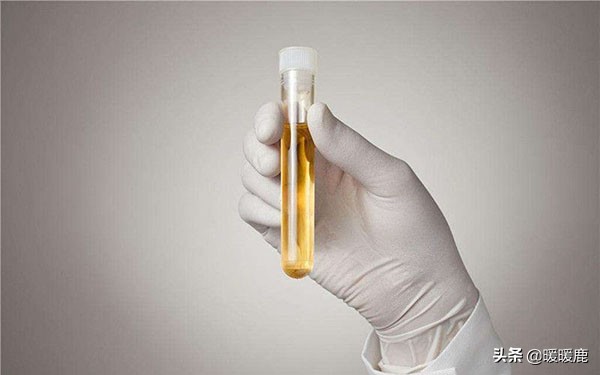 孕妇尿酮体和尿糖同时出现,怀孕尿蛋白尿糖高是怎么回事