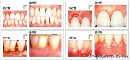 比较严重的牙周炎,时不时会流牙血应该如何治疗？