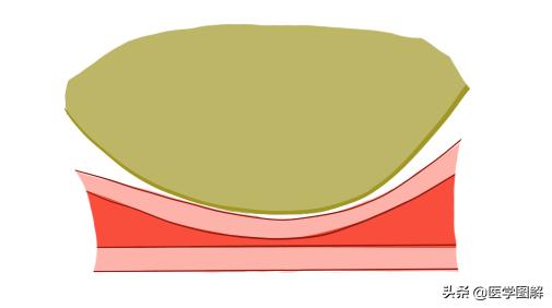 子宫肌瘤，比你想象的可怕！瞬间就危在旦夕？丨医学图解