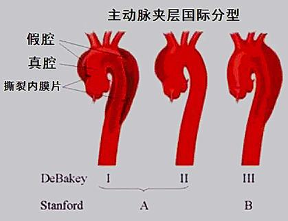 致命的主动脉夹层,主动脉夹层最危险的生命杀手
