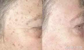斑到底怎么样才真正去掉,斑怎么祛除最快最有效