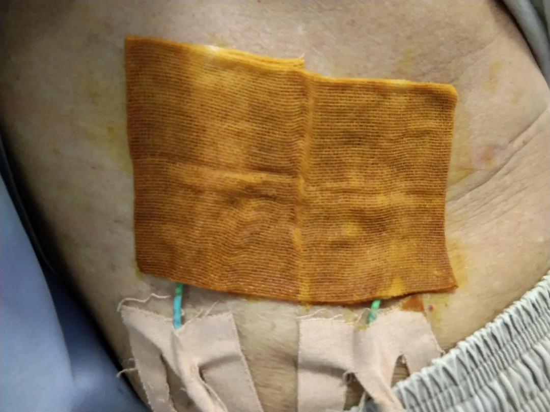 拜尔坦泡沫敷料能促进伤口愈合吗,什么样的病人应该用泡沫敷料