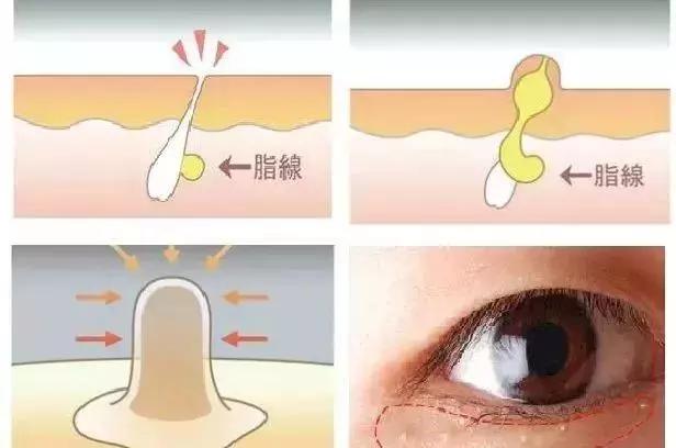 脂肪粒应该怎样用针挑,脂肪粒用针挑越挑越多