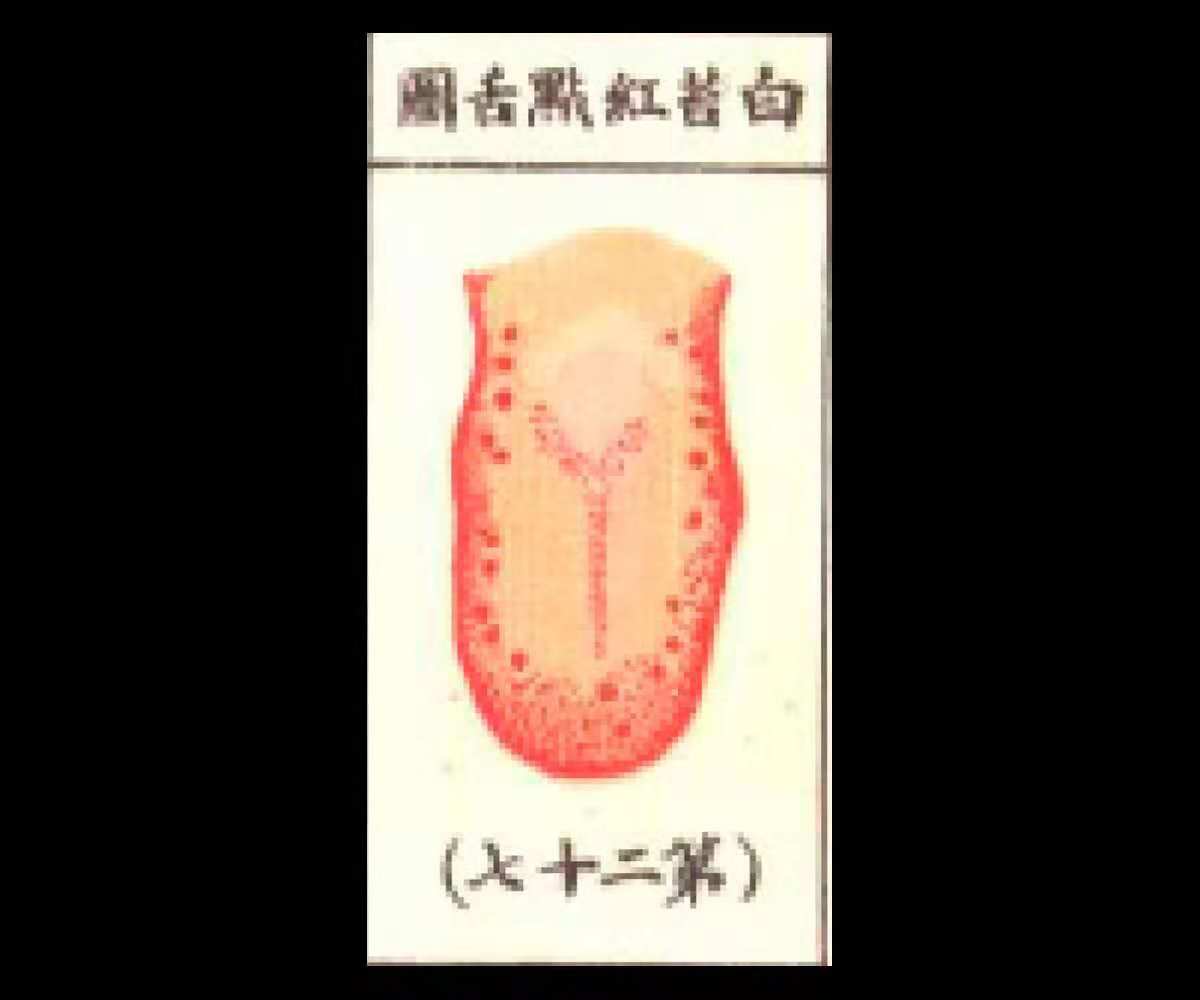 白苔有红点食疗,舌苔白中带灰黑中医如何辨证