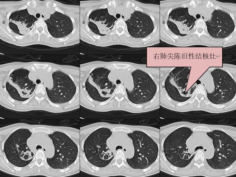颈部肿块为什么有80%是肿瘤,颈部肿块1年没有变化