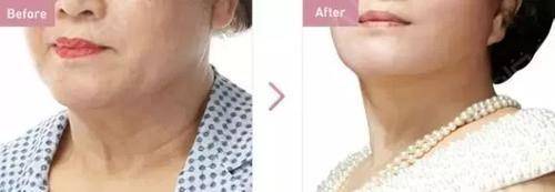 面部衰老改善最好的方法,衰老与面部轮廓的变化