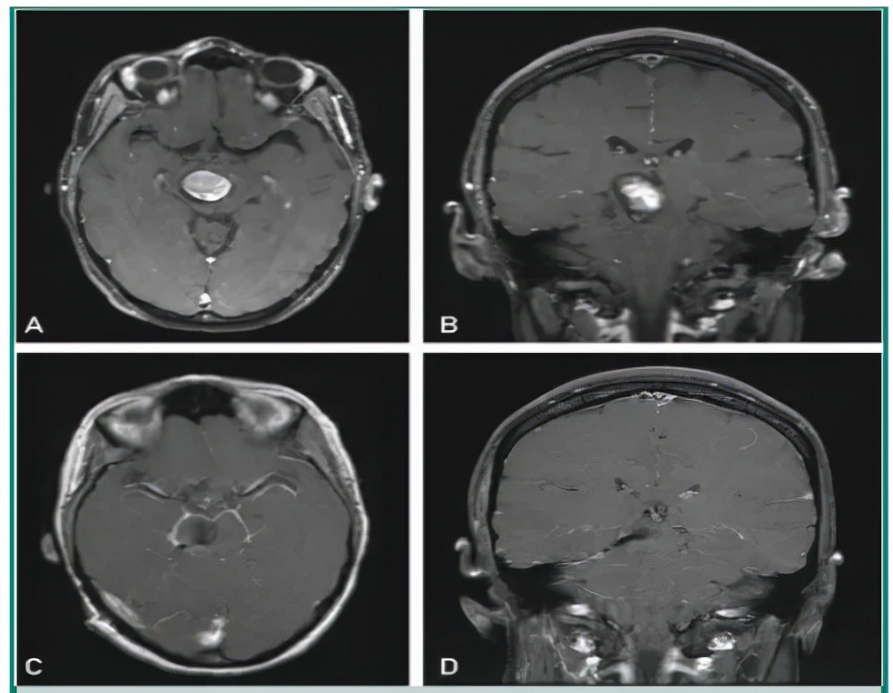 颅内海绵状血管瘤能治好吗,什么是颅内海绵状血管瘤