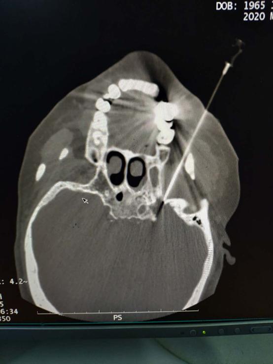 一针消除三叉神经,三叉神经痛一针8000