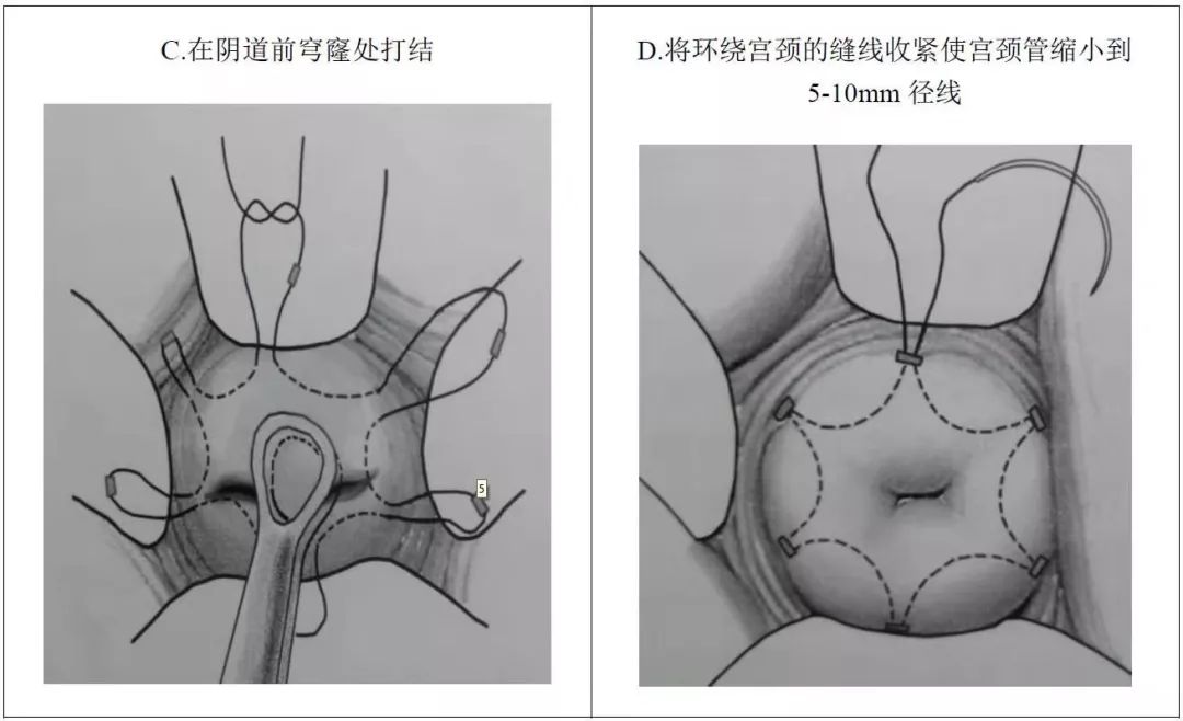 孕期宫颈环扎是怎么做,宫颈机能不全做环扎成功率有多高