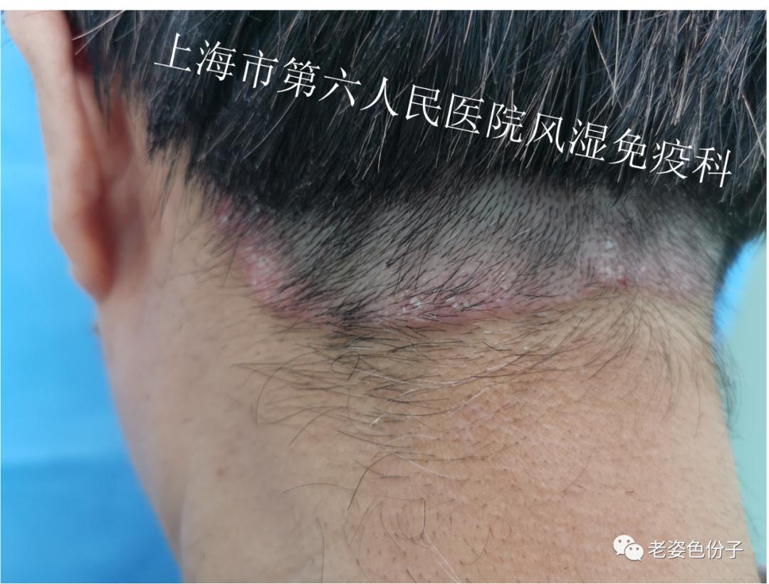 银屑病脚趾关节浮肿是怎么回事,银屑病关节炎会使脚趾根部痛吗