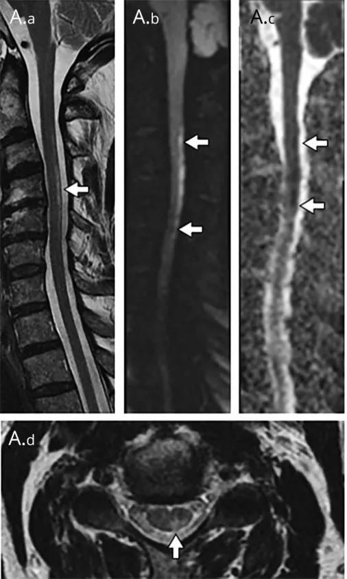 脊髓病变案例图文问诊,脊髓病变视频