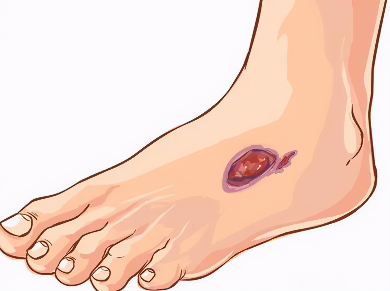 重视足部护理，50%的糖尿病足溃疡其实可以预防