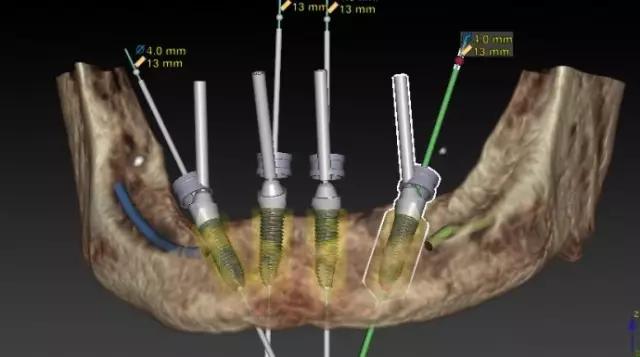 种植牙牙齿缺失最好的修复方案,半口种植牙即刻修复多久能吃东西