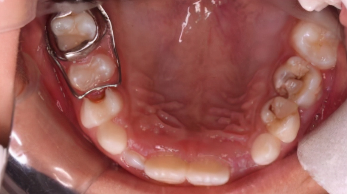 为什么乳牙好换牙就不好了,为什么现在的孩子换的门牙特别大