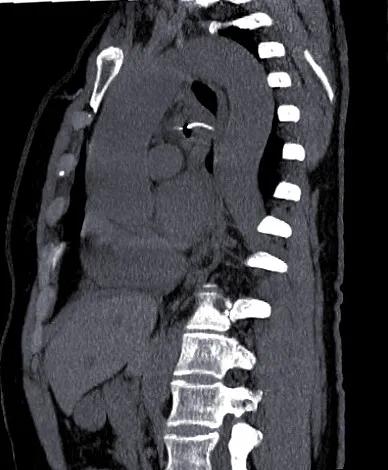鱼刺卡住吞饭更严重示意图,鱼刺卡喉吃馒头咽下去了会怎样