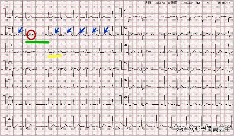心电图一二三代表什么,心电图一二三导联示意图