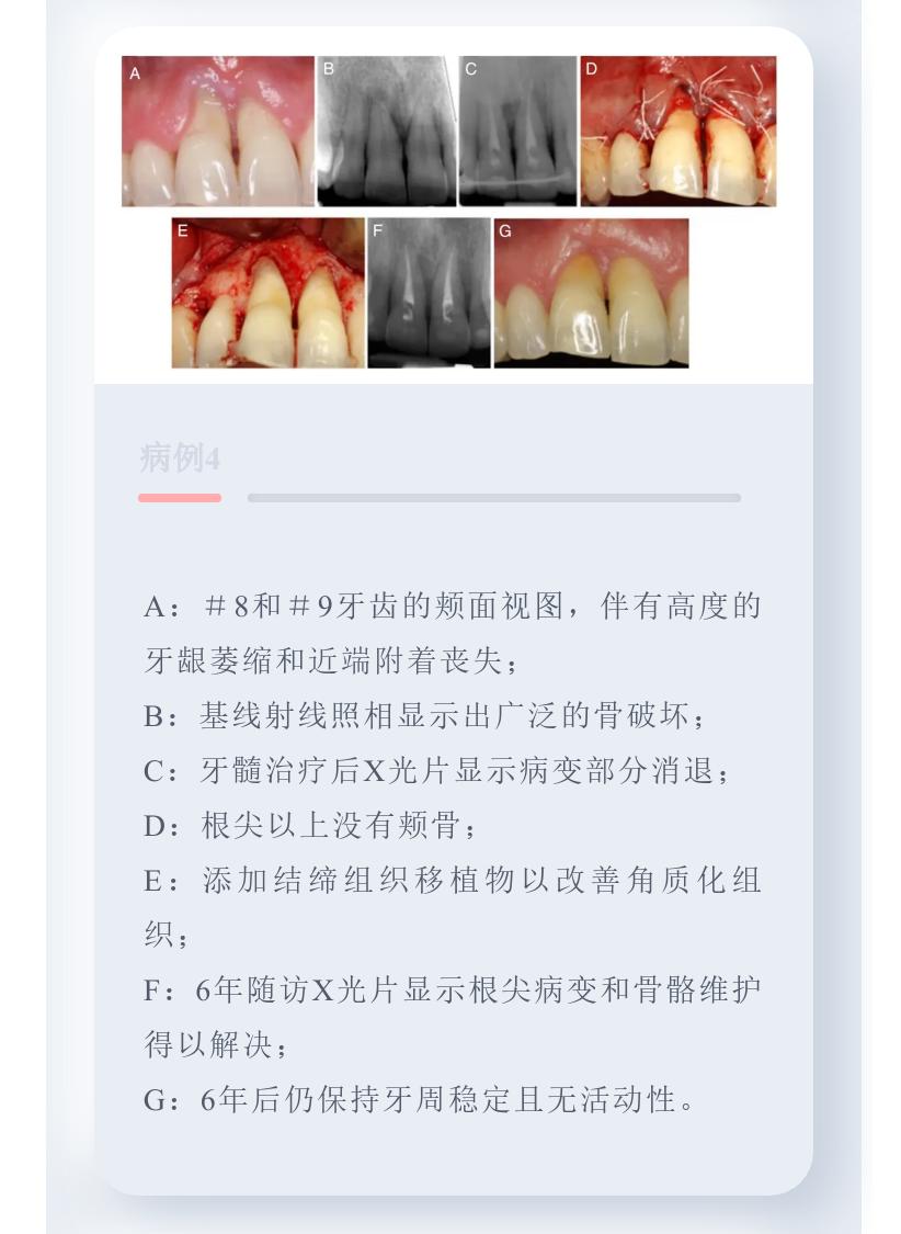 牙周病引起的牙髓病变的治疗原则,牙周组织可以修复再生吗
