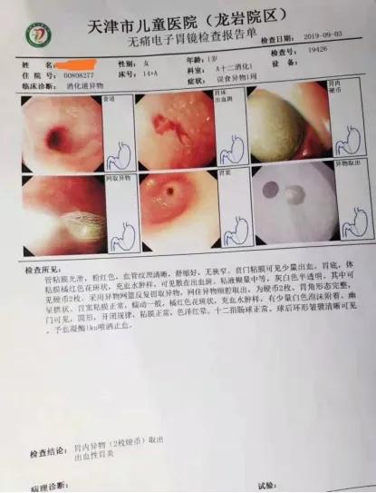 儿童误吞异物的正确方法,孩子不小心吞入异物卡住了怎么办