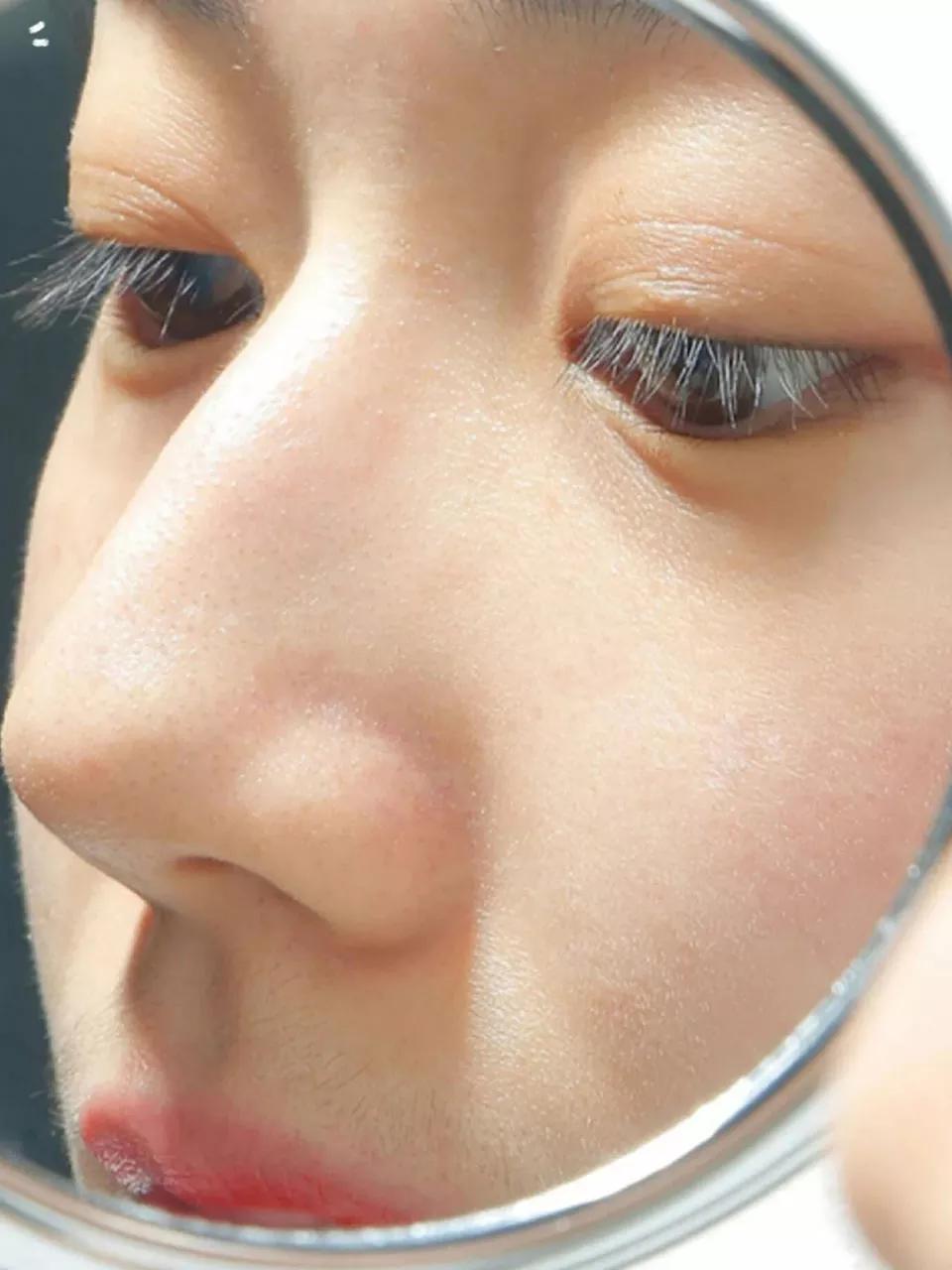 生理盐水把痘消了,去痘痘黑头和痘印