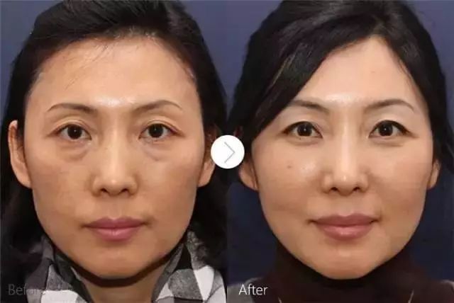 线雕热玛吉拉皮超声刀的区别,热玛吉超声刀线雕后遗症有多严重