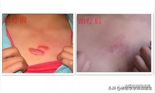 瘢痕疙瘩毛细血管扩张,毛细血管瘤治疗后留疤怎么去除