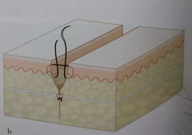 刀口闭合需要多久,伤口闭合除了缝针还有什么方法