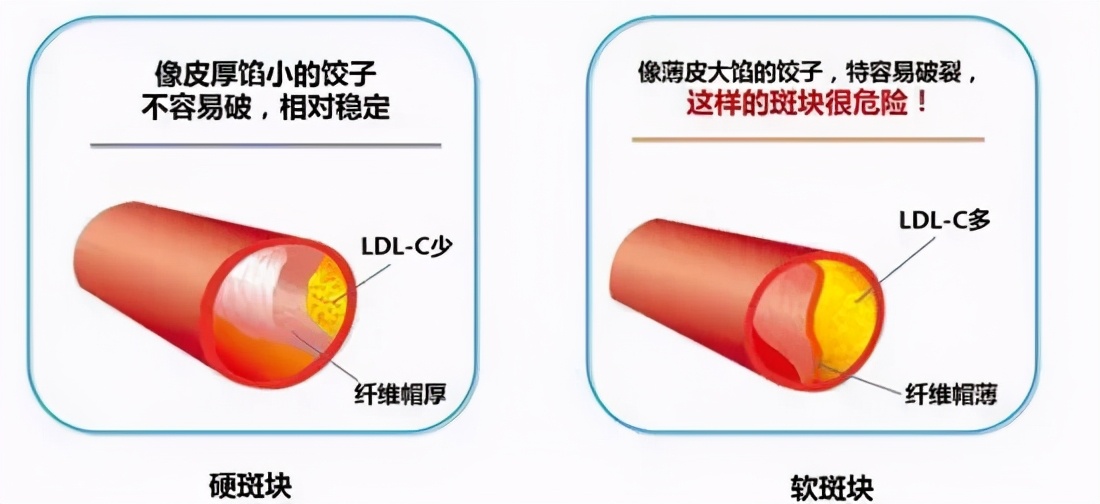 动脉斑块多长时间可以逆转消失,心脏动脉斑块可以消除吗