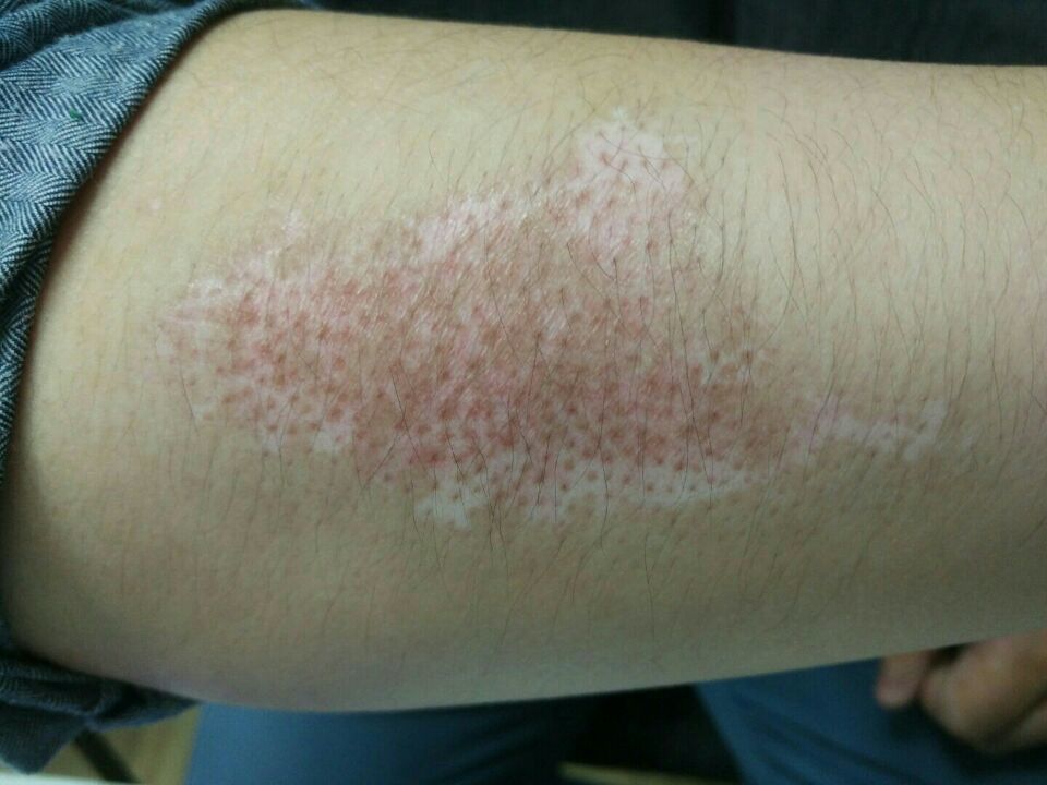 白癜风是否在康复？需要满足这5个条件