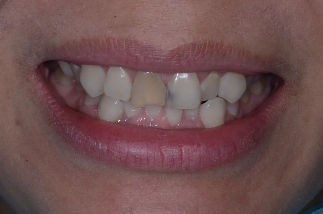 美白牙膏去牙黄真实有效测评,美白牙膏真实测评护牙效果