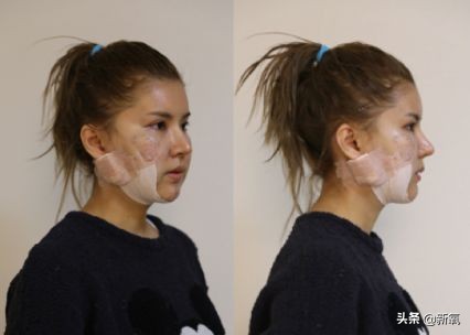 18岁土肥圆豪掷800万全身整形，鼻子6次大整假体穿出，效果却超美