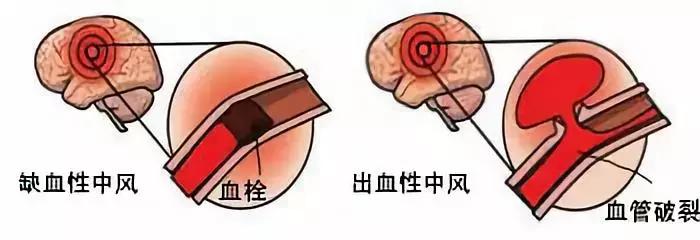 血管有杂质是什么症状,血管里有垃圾和毒素吗