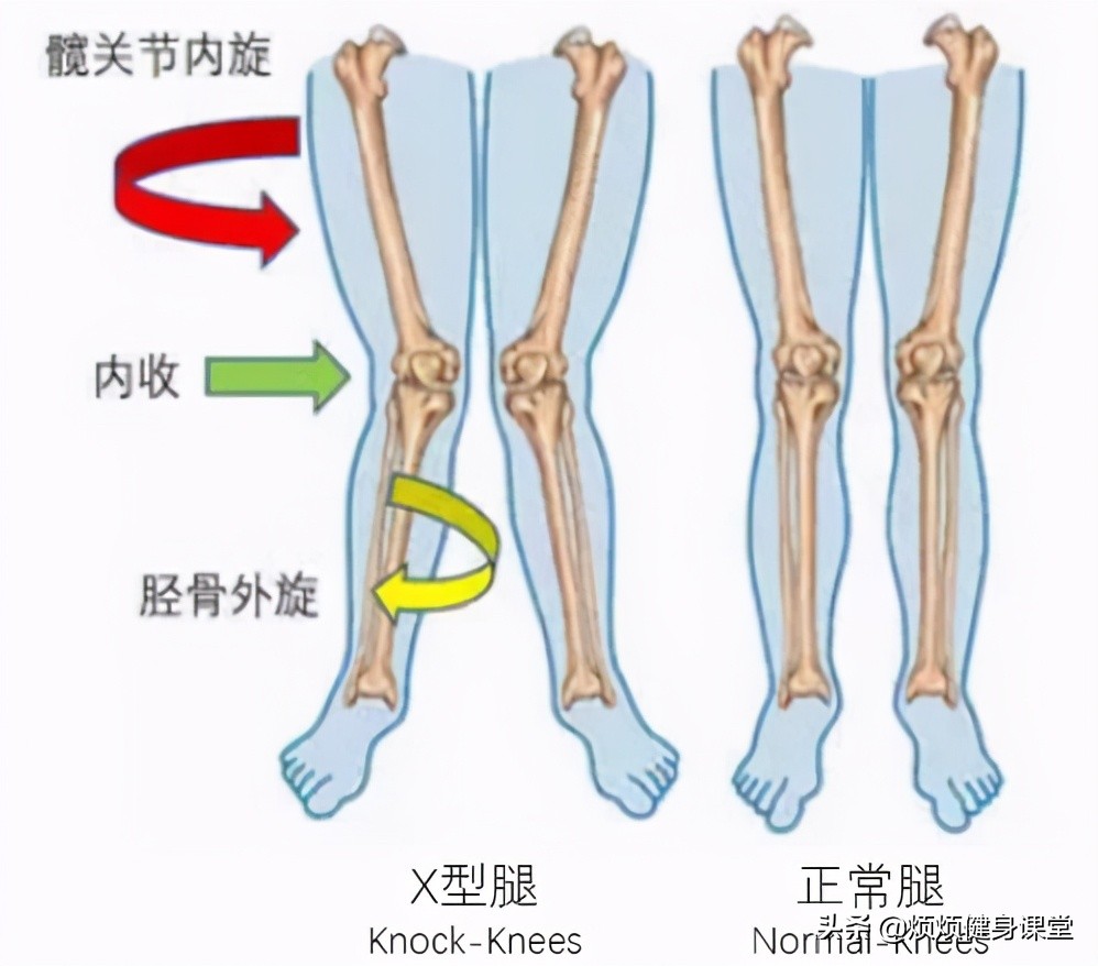 经期怎么改善膝盖内扣,膝盖内扣小腿外翻怎么矫正