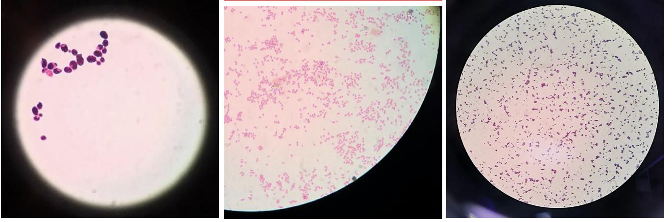 小腹痛、白带脓性,先看看这个检查