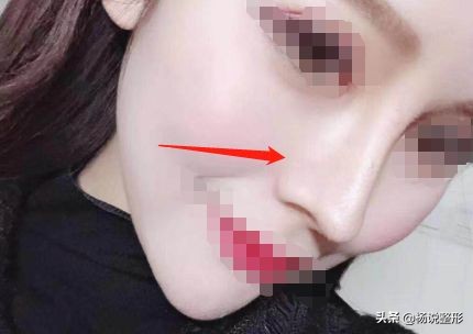 隆鼻整容老了会怎么样,隆鼻后老了