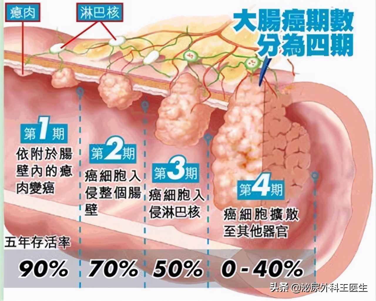 男子每天大便两三次结果是肠癌,大便带血的肠癌怎么判断早期晚期