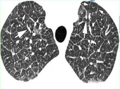 肺部ct十大征象,肺部ct正常图和异常图的区别