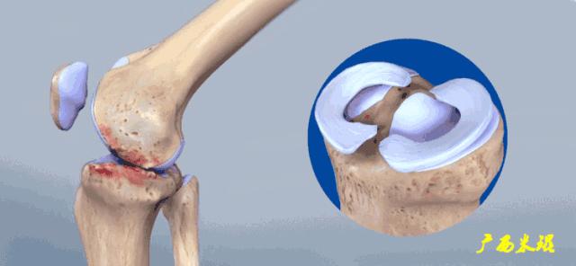 有关半月板的疾病与治疗,听骨科医生讲的话