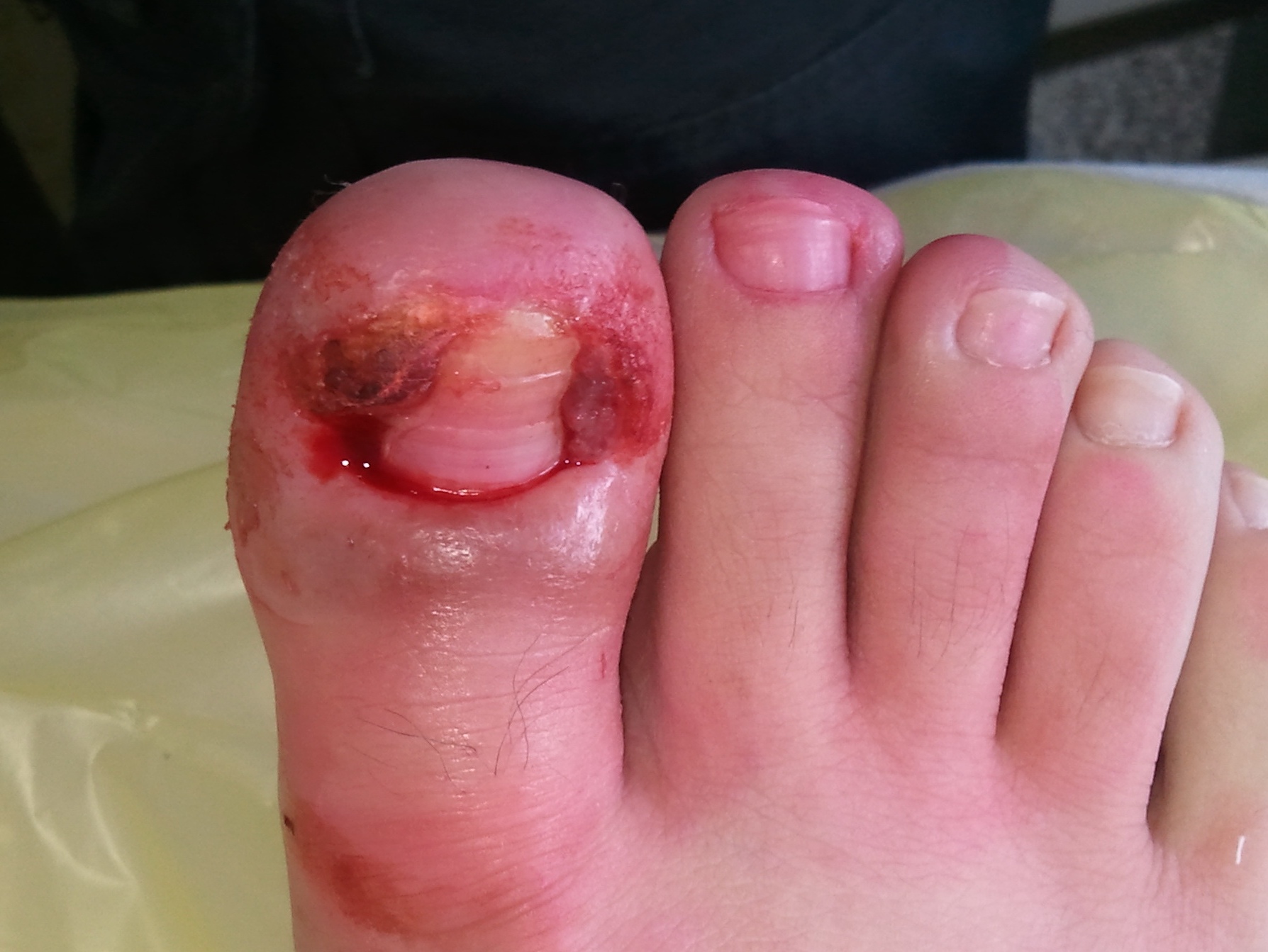 得了甲沟炎就要去修脚吗,得了甲沟炎必须得拔甲吗