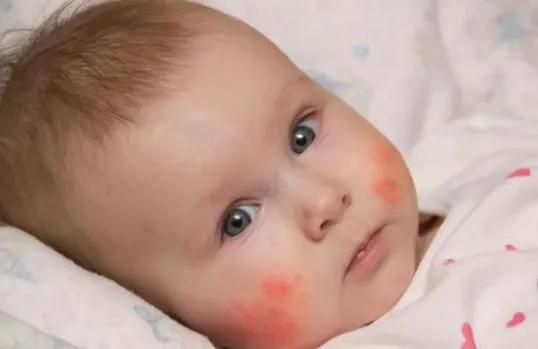 换季宝宝皮肤干痒敏感？专家支招，3步搞定