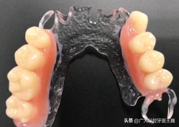 假牙哪种材料戴起来舒服,假牙挑选