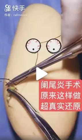 我在快手上看人切洋葱，竟然弄懂了剖腹产？