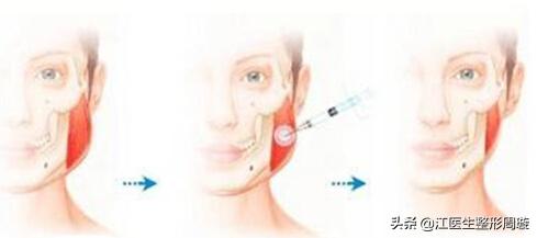 瘦脸针敢不敢打,瘦脸针不要随便打