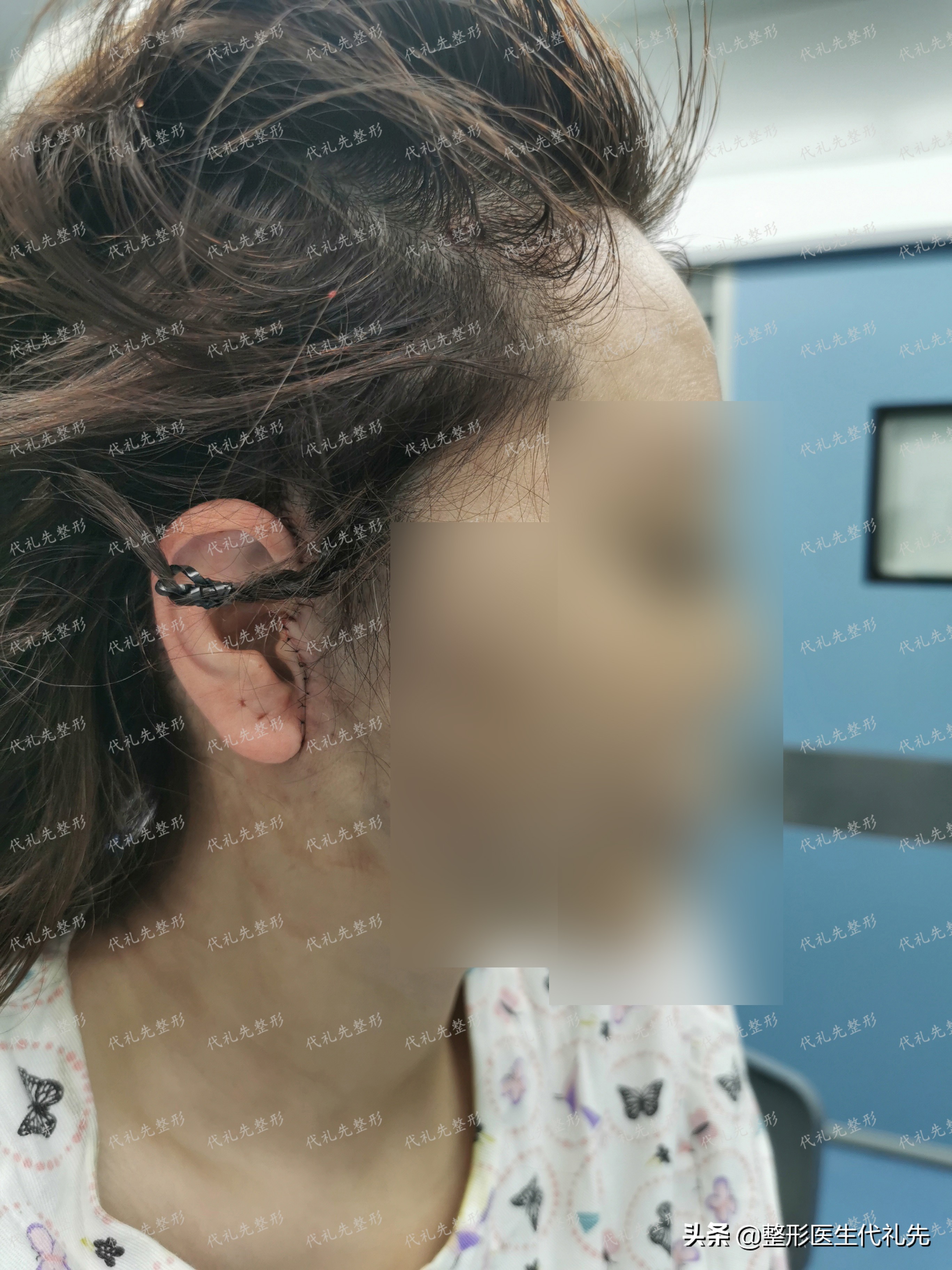 大拉皮和面部微创提升术的区别,小切口面部提升是小拉皮手术吗