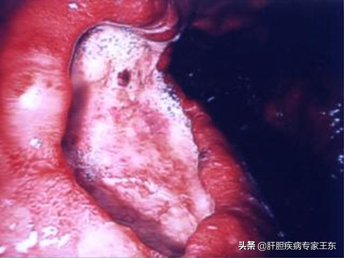 饮酒醉了吐血了怎么办,大量饮酒后吐血是怎么回事