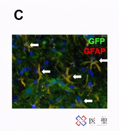日本渐冻人症特效药 (渐冻人症细胞治疗)
