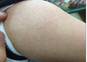 去鸡皮肤的用药步骤,鸡皮肤去除最便宜高效的方法