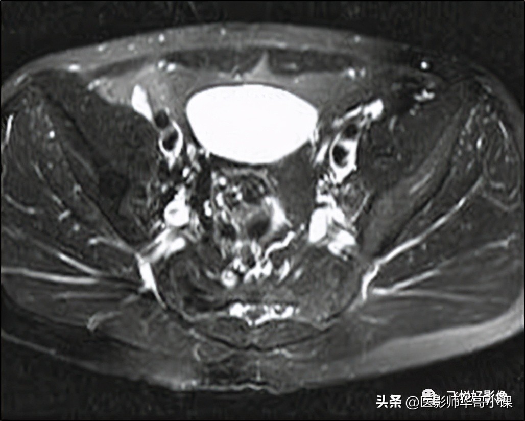飞利浦磁共振独有技术,飞利浦磁共振减影技术