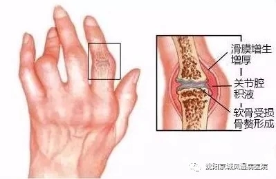 沈阳京城类风湿医院,沈阳京城医院治疗类风湿靠谱吗